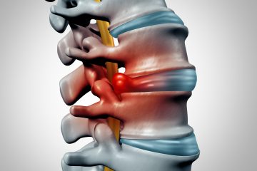 Spinal Decompression